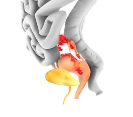 Endometriosis, illustration
