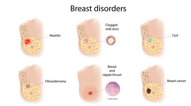 Female breast disorders, illustration