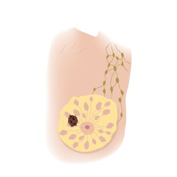 Breast cancer at stage T2, illustration