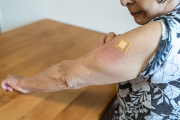 新型コロナウイルス(COVID-19)予防のためのワクチン接種の副作用で、注射した左腕が赤く腫れ痛みを訴えるシニア女性