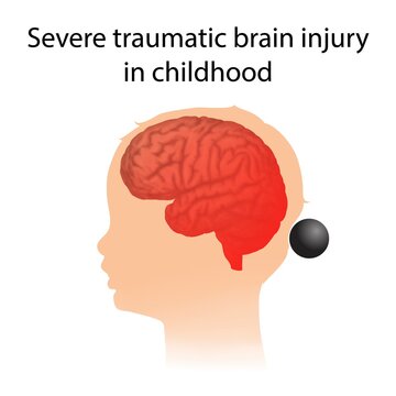 Severe traumatic brain injury in childhood, illustration