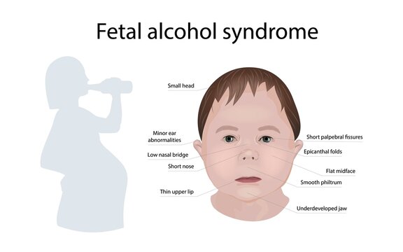 Foetal alcohol syndrome, illustration