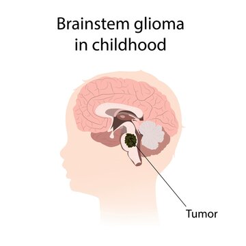 Brainstem glioma in childhood, illustration
