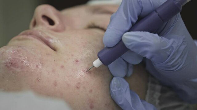 Cosmetological procedure, operation. The doctor treats problem skin with pimples and acne. Laser for healthy skin. A woman lies in the medical office of a dermatologist. Laser peeling and cryoplasma.
