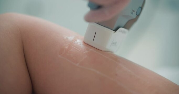Close-up arm, a client having a lifting procedure by using the Ultraformer apparatus.