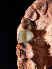 Ceramic tooth crown.