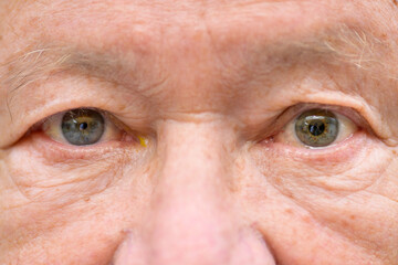 Elderly man suffering from anisocoria showing unequal pupils
