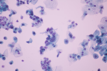View in microscopic of Abnormal human cervix cells.Squamous epithelium cells.Superficial and intermediate epithelial cells.Cytology and pathology laboratory department.Magnification 400 X