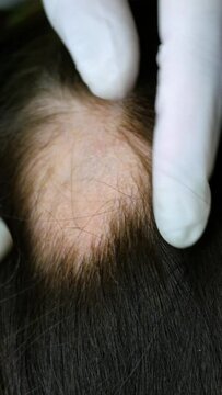 Microsporia Bilder Durchsuchen 29 Archivfotos, und