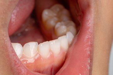 Selective Focus Close Up of a 4 year old kids whose first milk teeth