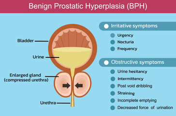 Benign Prostatic Hyperplasia (BPH)