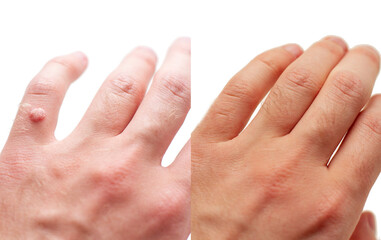 Laser treatment for wart removal before and after. - obrazy, fototapety, plakaty