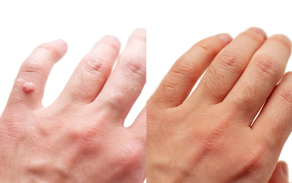 Laser treatment for wart removal before and after.