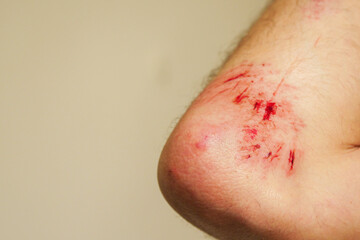 Fresh bleeding wound caused by falling on a hard rocks in a mountain