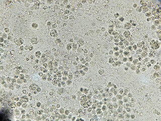 Urine sediment microscopic show plenty of pus cells or white blood cell and few RBC or red blood...