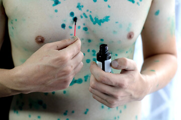 the whole body is covered with chickenpox