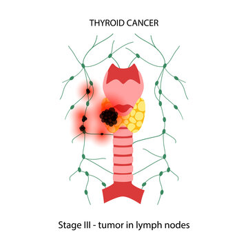 Thyroid cancer stages