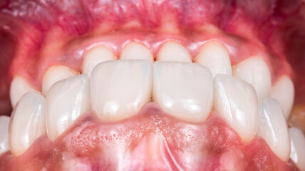 press ceramic crowns and veneers