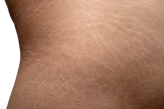 Stretch marks on woman's buttocks skin