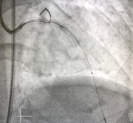 Intravascular ultrasound (IVUS) catheter advance to left anterior descending artery (LAD) after deployed Drug eluting stent (DES).