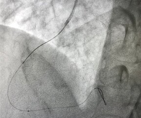 Intravascular ultrasound (IVUS) catheter advance to right coronary artery (RCA).
