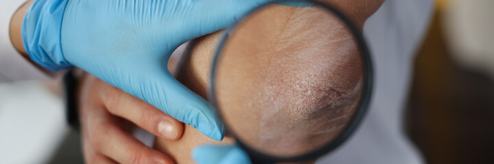 Doctor examines patient scaly elbow through magnifying glass
