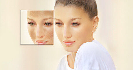 Fototapeta premium Dark spots, freckles,hyperpigmentation(melasma or chloasma),concept - skin lightening, skin whitening, fruit acids,AHA, Skin Brightening.