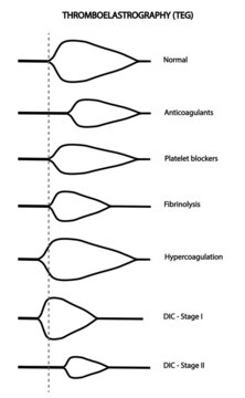 Thromboelastography (TEG). Blood coagulation analysis types. Different types of results 