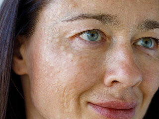 Real skin Biorevitalization on white background. Traces of biorevitalization injections on woman face. Biorevitalization needle marks Beauty treatment, real papules after hyaluronic injection Close up