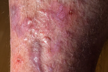 Spots of lichen planus on a male leg. Dermatological immune diseases.