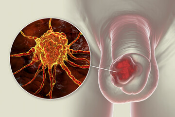 Penile cancer, 3D illustration showing malignant tumor on the human penis © Dr_Microbe