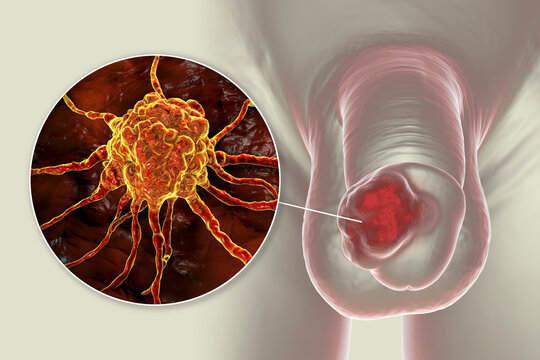 Penile cancer, 3D illustration showing malignant tumor on the human penis