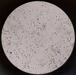 Microscopic view of urine RBC is called hematuria, serious causes of hematuria include kidney or...