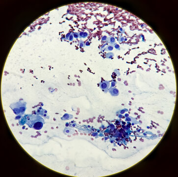Photomicrograph of Metastatic Squamous cell carcinoma, background reactive hepatocytes and blood, 40x view