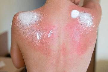 Woman's back skin hurt from sun burn. Protective aerosol is applied to sunburn on woman's back.