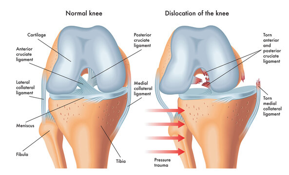 Medical illustration of symptoms of dislocated knee, with annotations.