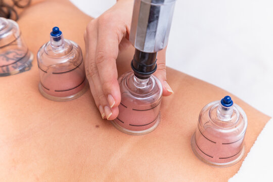 Woman lying on her chest with cupping treatment on her back. woman doing sucker