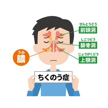 蓄膿症男性の鼻の内部イメージ