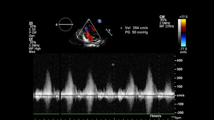 Image of the heart during transesophageal ultrasound with Doppler mode.