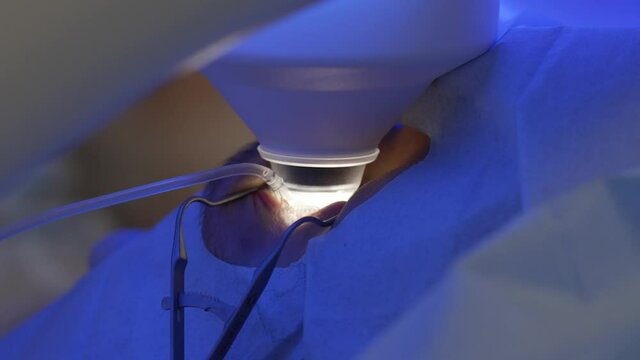 Laser eye correction using SMILE method