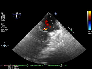 Image of the heart during transesophageal ultrasound with Doppler mode.