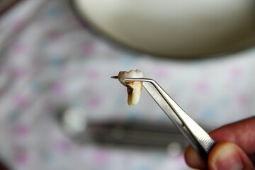 Extracted wisdom tooth in a tweezers
