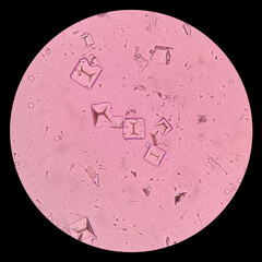 Urine sediment showing Struvite  crystals, spermatozoa, RBC and squamous epithelial cells. Triple...