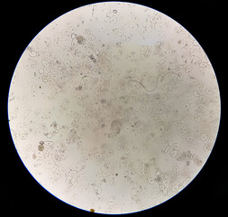 Abnormal result of urinalysis examination from microscopic method under 40X light microscope; show...