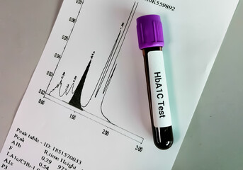 Blood sample for HbA1c (Hemoglobin A1c) test. Diabetic treatment monitoring test.