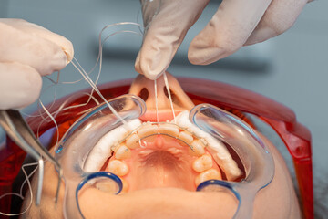 placing the fixed retainer in Process of removing dental braces from a Caucasian girl in a dental clinic with a female dentist - obrazy, fototapety, plakaty