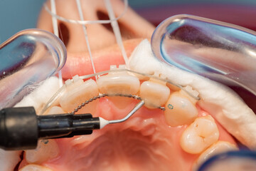 placing the fixed retainer in Process of removing dental braces from a Caucasian girl in a dental...