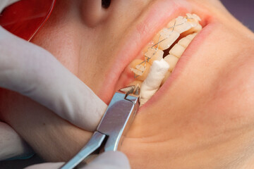 removing the brackets from the dental braces in process of removing dental braces from a Caucasian...