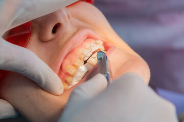 removing the brackets from the dental braces in process of removing dental braces from a Caucasian girl in a dental clinic with a female dentist