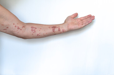 First degree burnt with hot cooking oil man.s arm